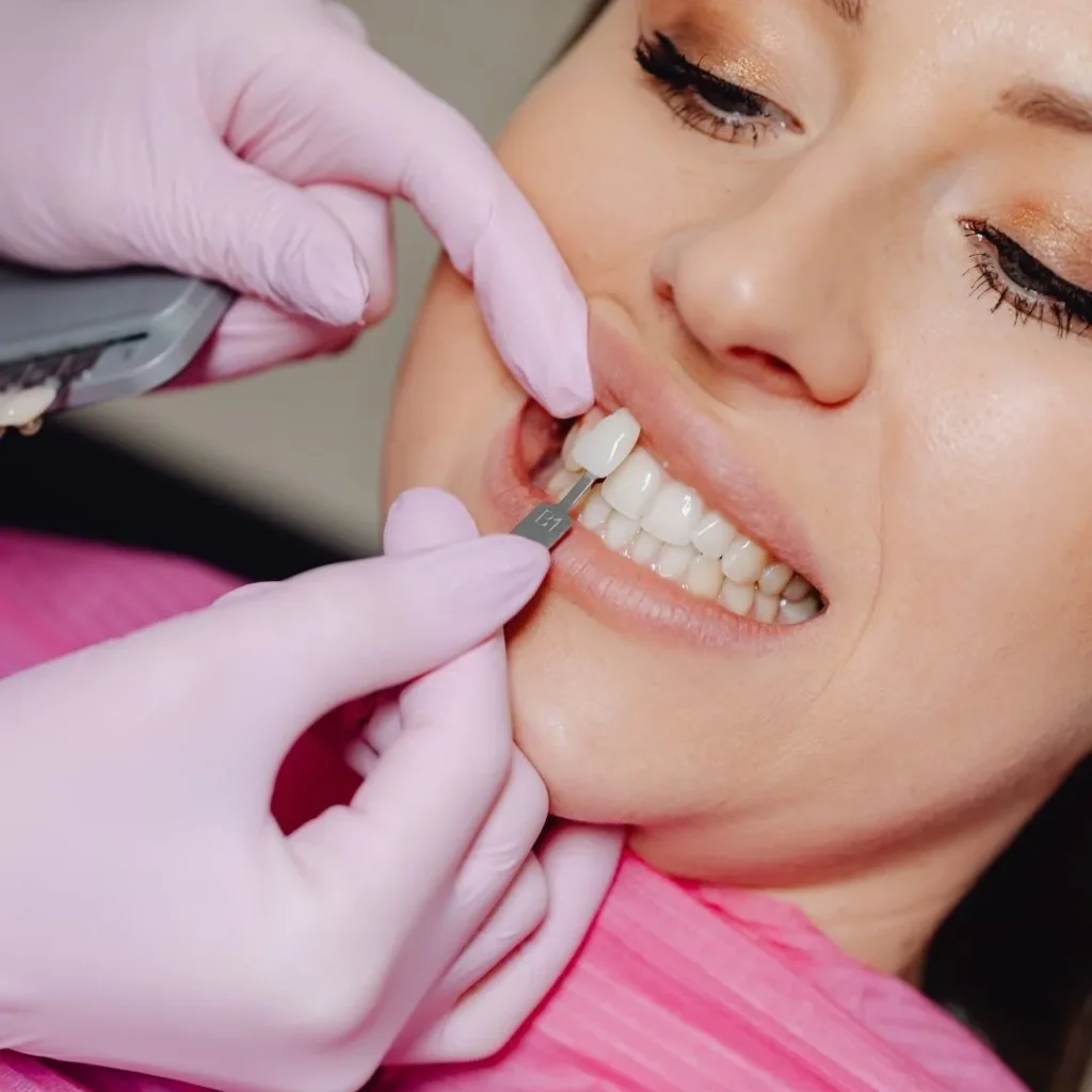 faccette dentali a Siracusa e Pozzallo