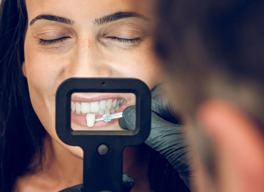 faccette dentali a Siracusa e Pozzallo