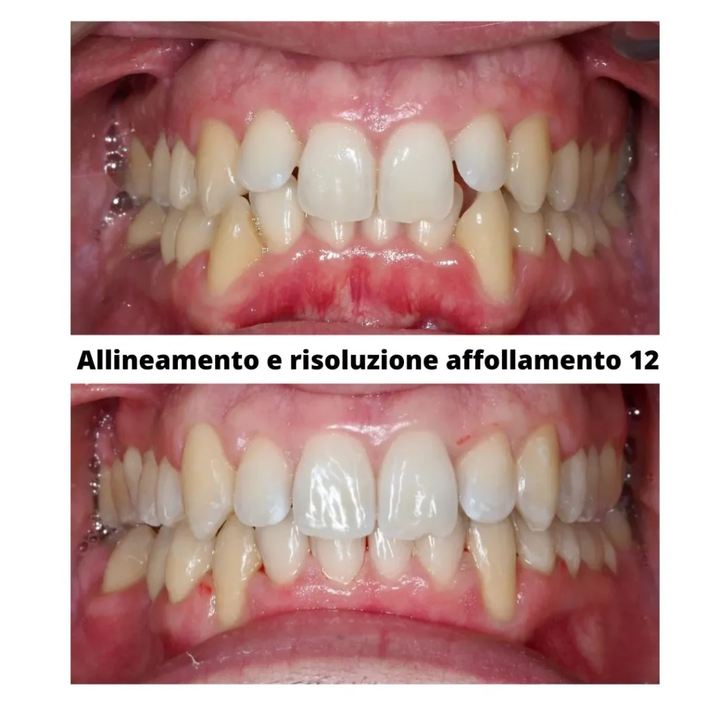 Apparecchio trasparente a Siracusa e Pozzallo