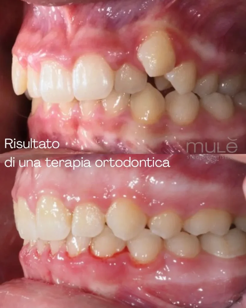 Apparecchio trasparente a Siracusa e Pozzallo