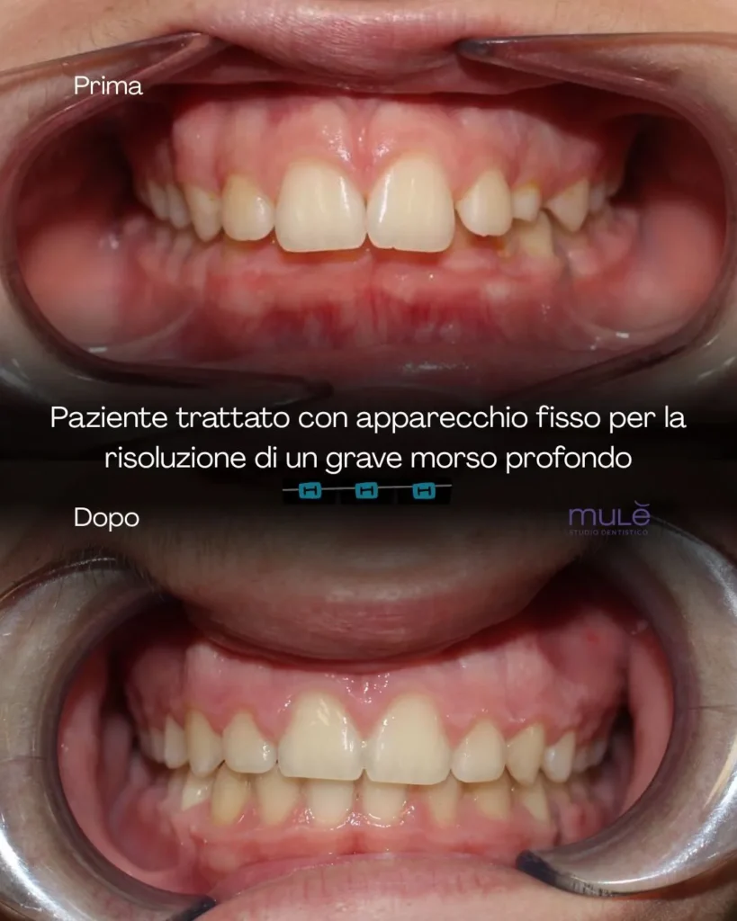 Apparecchio dentale a Siracusa e Pozzallo