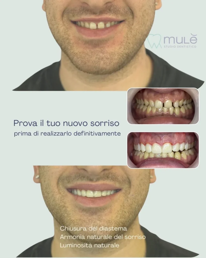 Faccette dentali a Siracusa e Pozzallo