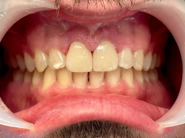 Faccette dentali a Siracusa e Pozzallo