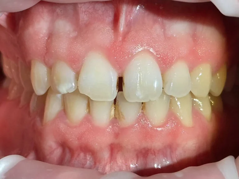 Faccette dentali a Siracusa e Pozzallo