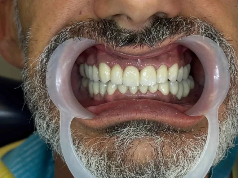 Faccette dentali a Siracusa e Pozzallo