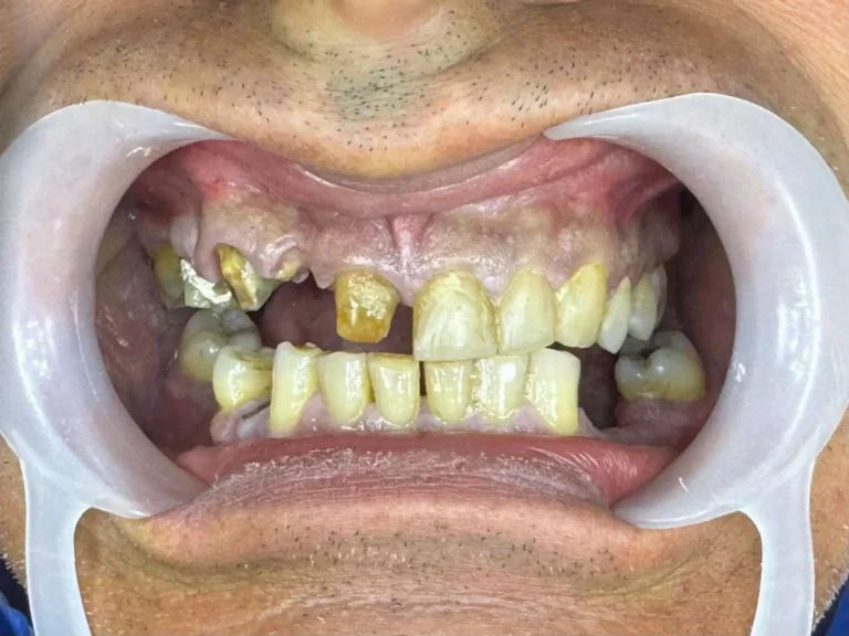 Faccette dentali a Siracusa e Pozzallo