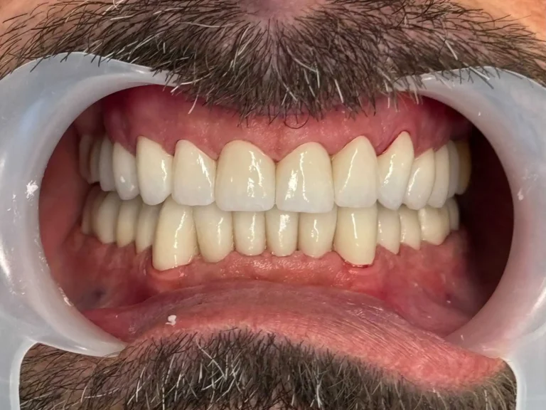 Faccette dentali a Siracusa e Pozzallo