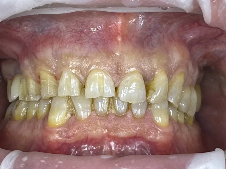 Faccette dentali a Siracusa e Pozzallo