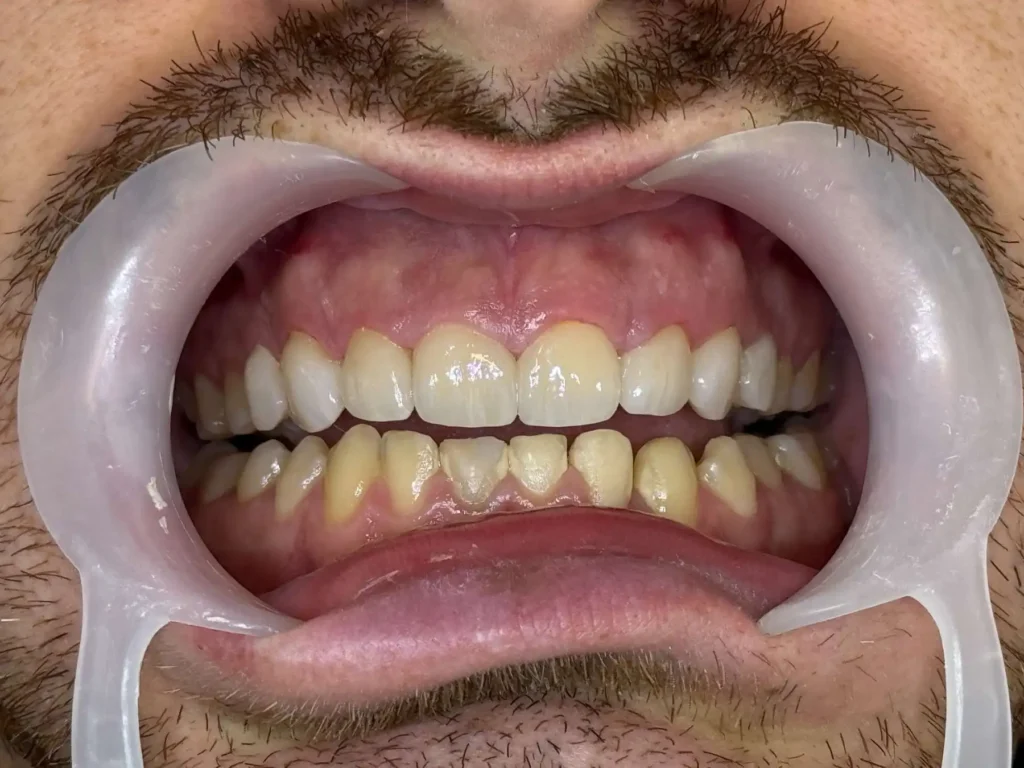 Faccette dentali a Siracusa e Pozzallo