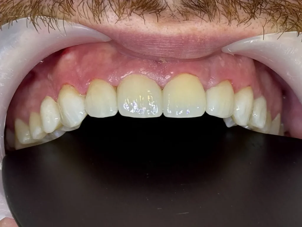 Faccette dentali a Siracusa e Pozzallo