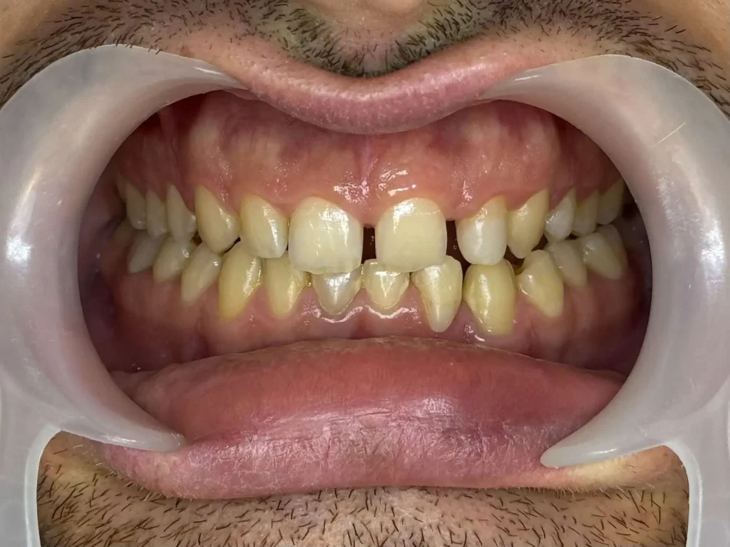 Faccette dentali a Siracusa e Pozzallo