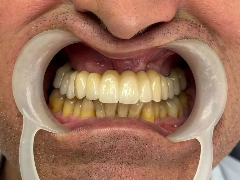Impianto dentale a Siracusa e Pozzallo