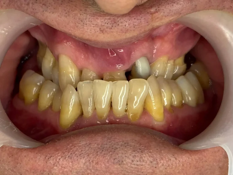 Impianto dentale a Siracusa e Pozzallo
