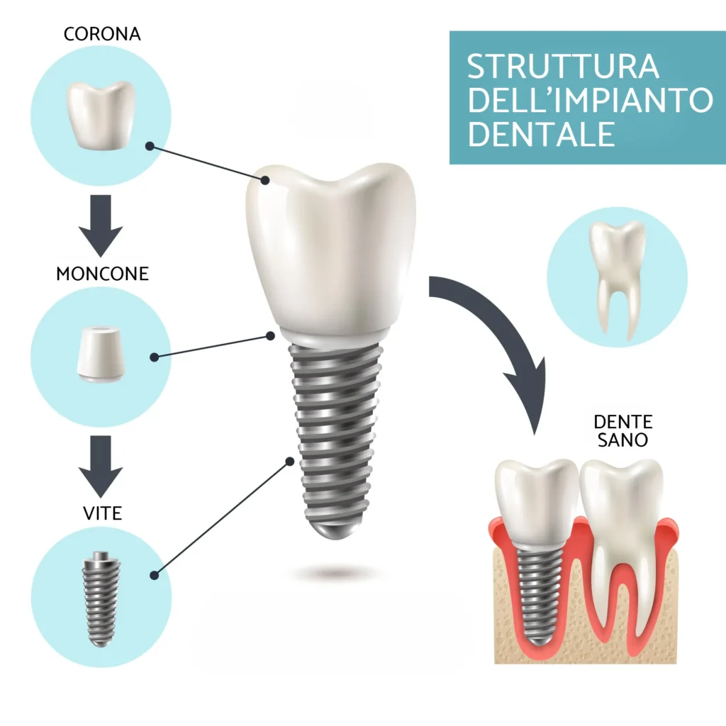 impianto dentale a Siracusa e Pozzallo